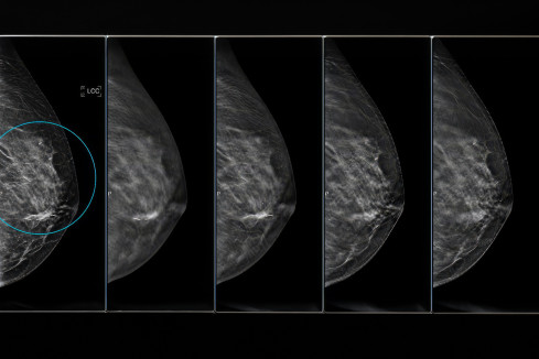Thumbnail of 3D Mammography