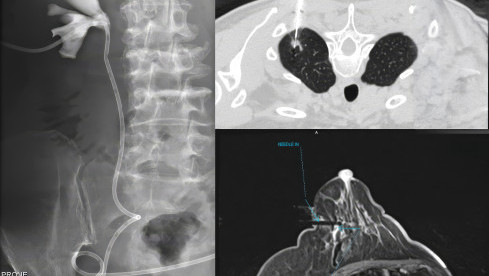 Thumbnail of Interventional Radiology