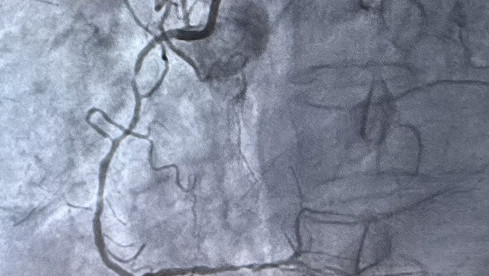 Thumbnail of Coronary Angiography and Percutaneous Coronary Intervention (PCI)