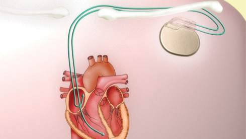 Thumbnail of Implantation of Cardiac Implantable Electronic Devices